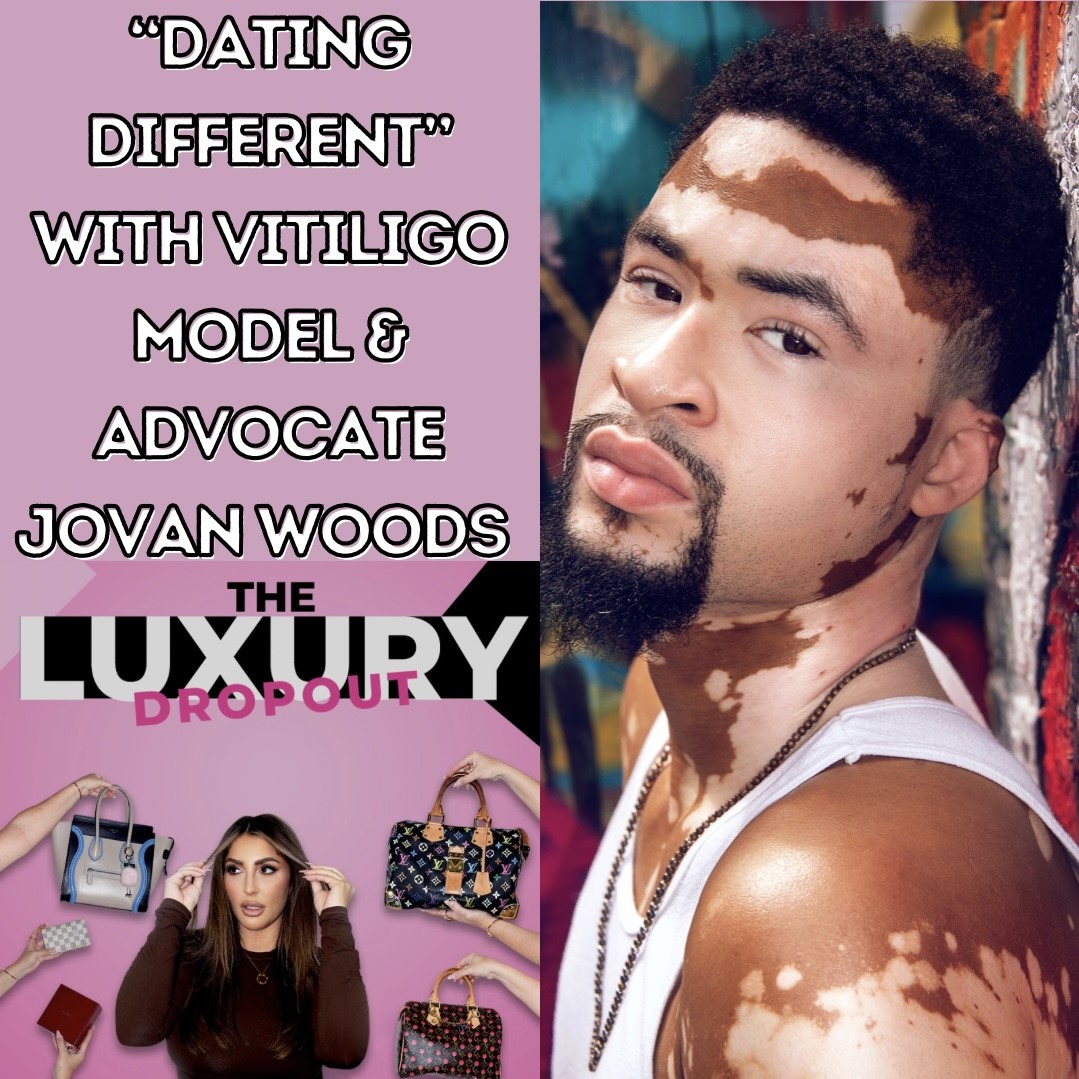 “Dating Different” With Vitiligo Model & Advocate Jovan “Jay” Woods